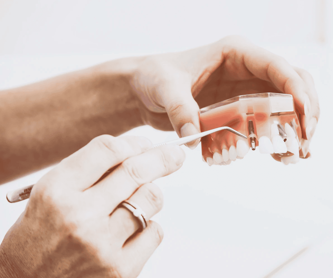 Dental Implant