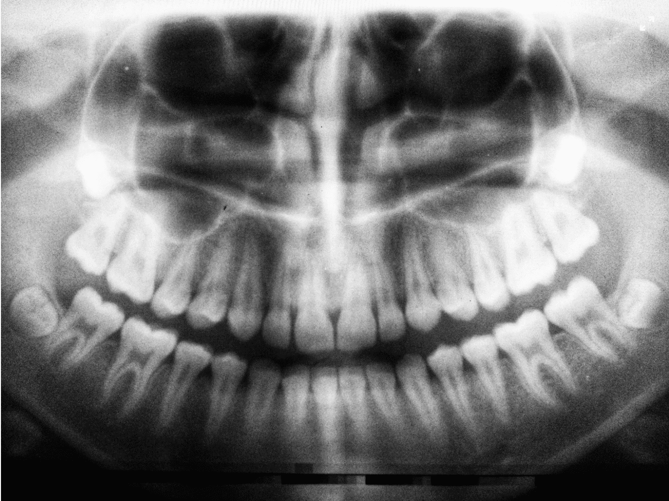 Dental Xray