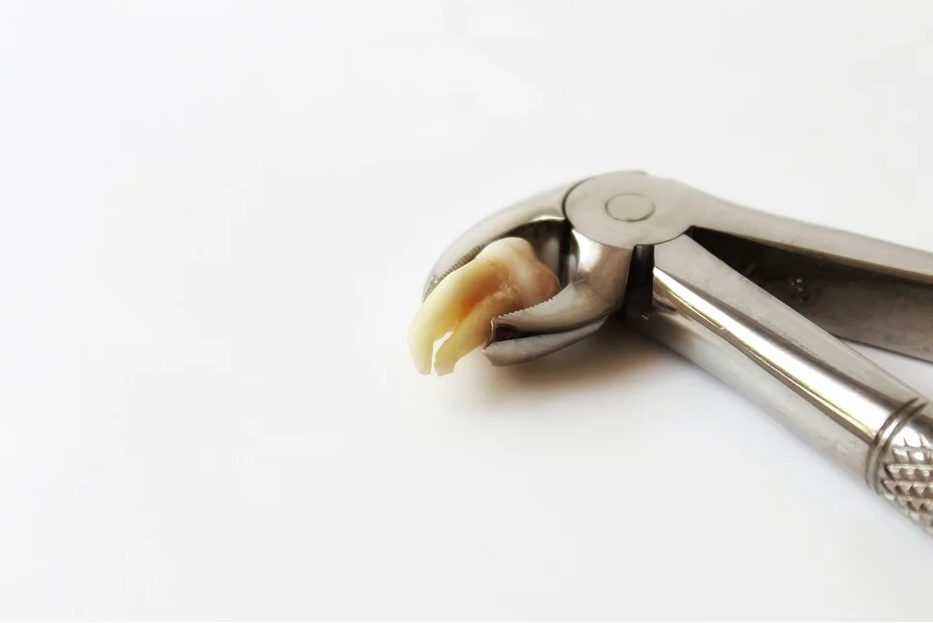Tooth Extraction Tooth Extraction