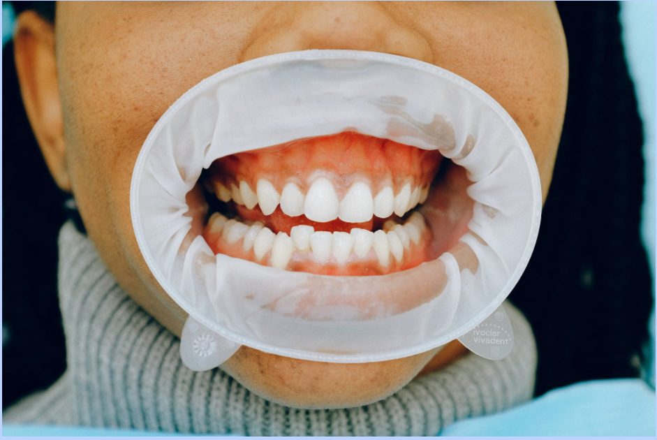 White Stuff on gums White Stuff on gums