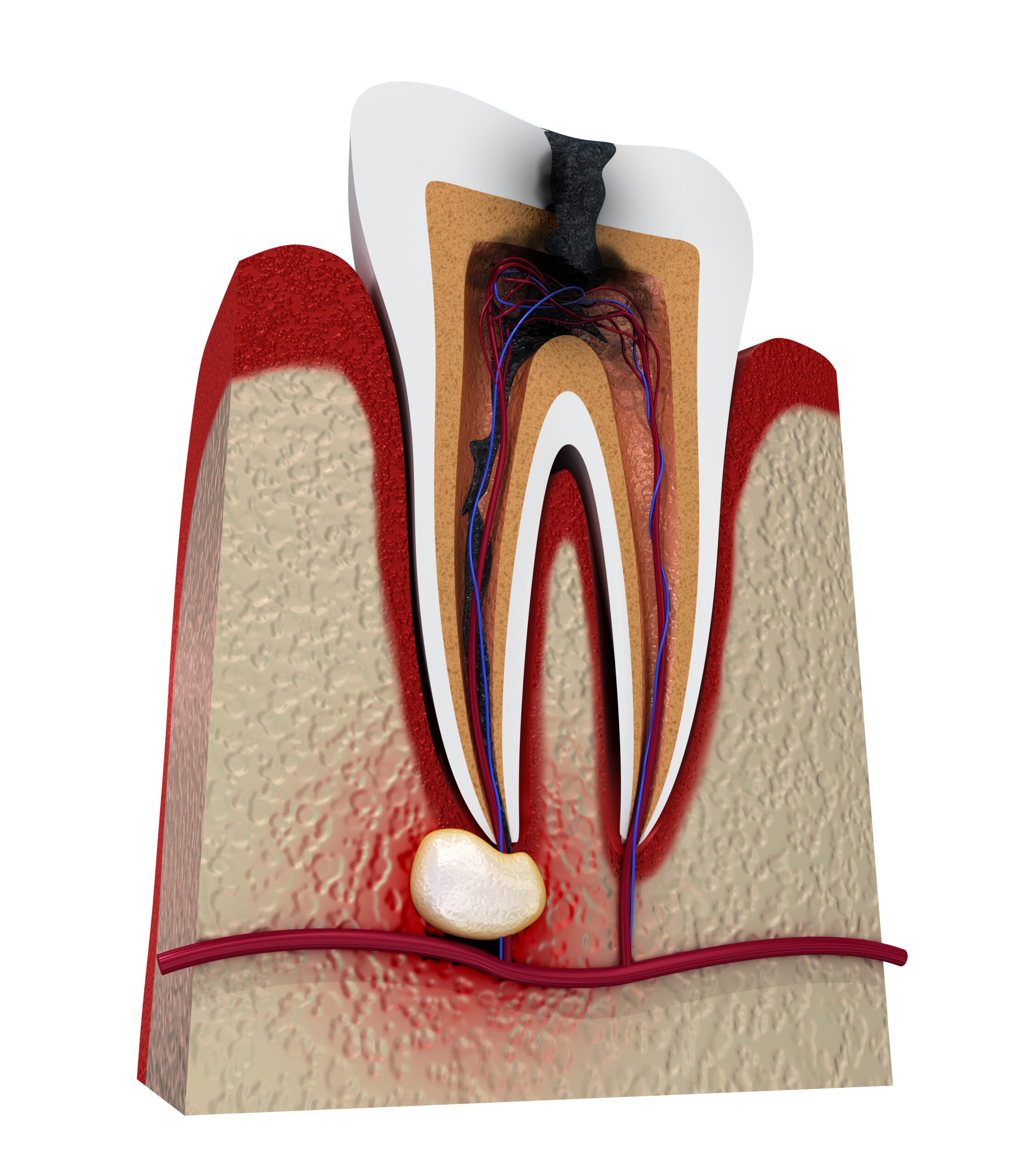 Patient Empowered Dentistry – Understanding Gum Abscesses A Comprehensive Guide – 03