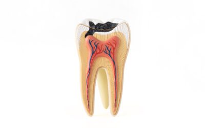 Navigating the Maze of Tooth Decay: A Comprehensive Guide on Teeth with Holes