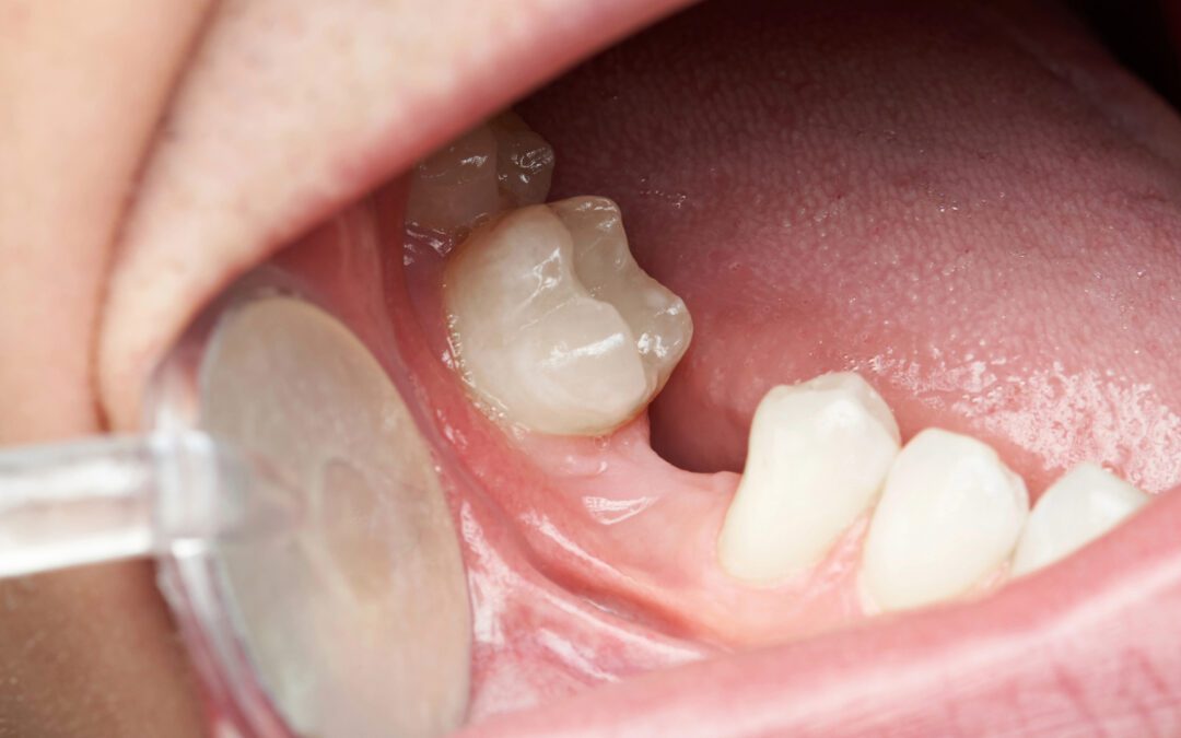 So You’re Getting a Tooth Pulled? Your Week-by-Week Recovery Guide