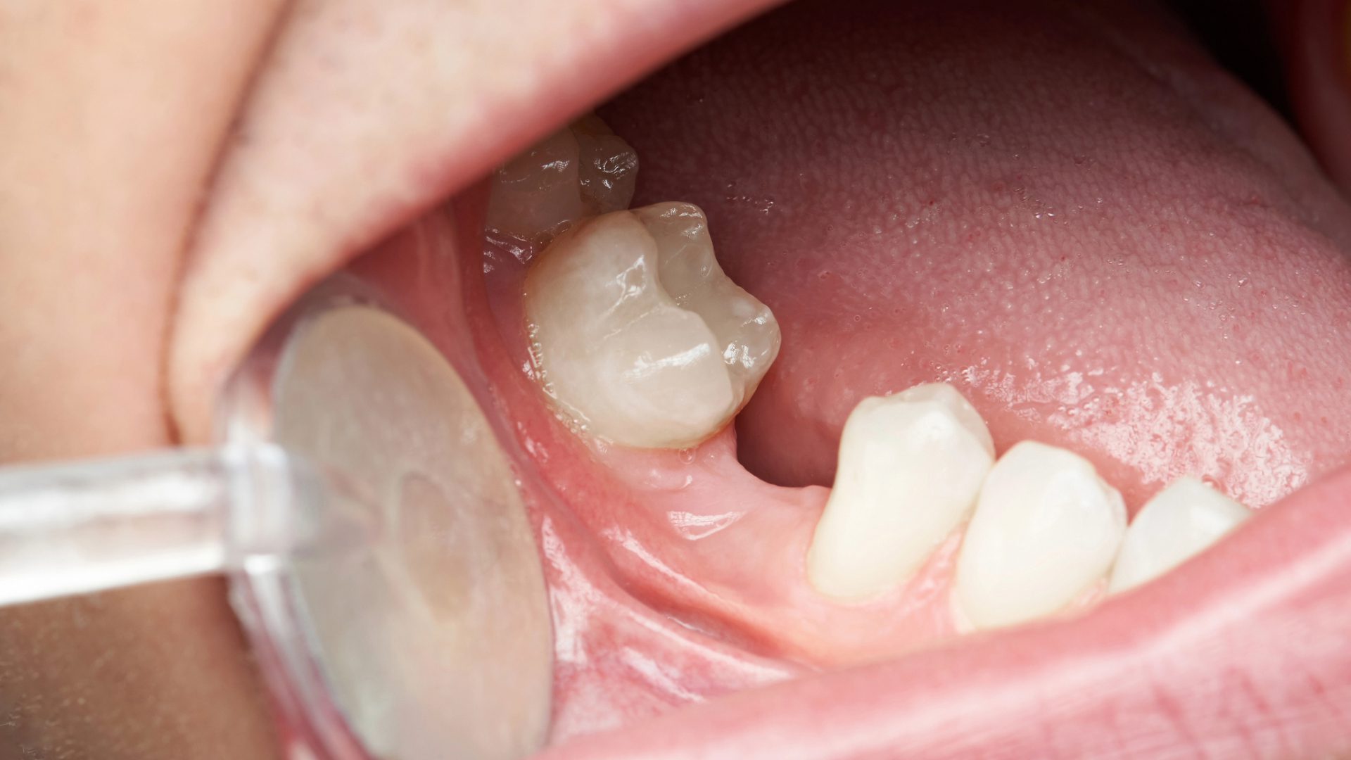 Patient Empowered Dentistry – So You’re Getting a Tooth Pulled – Your Week-by-Week Recovery Guide – Feature