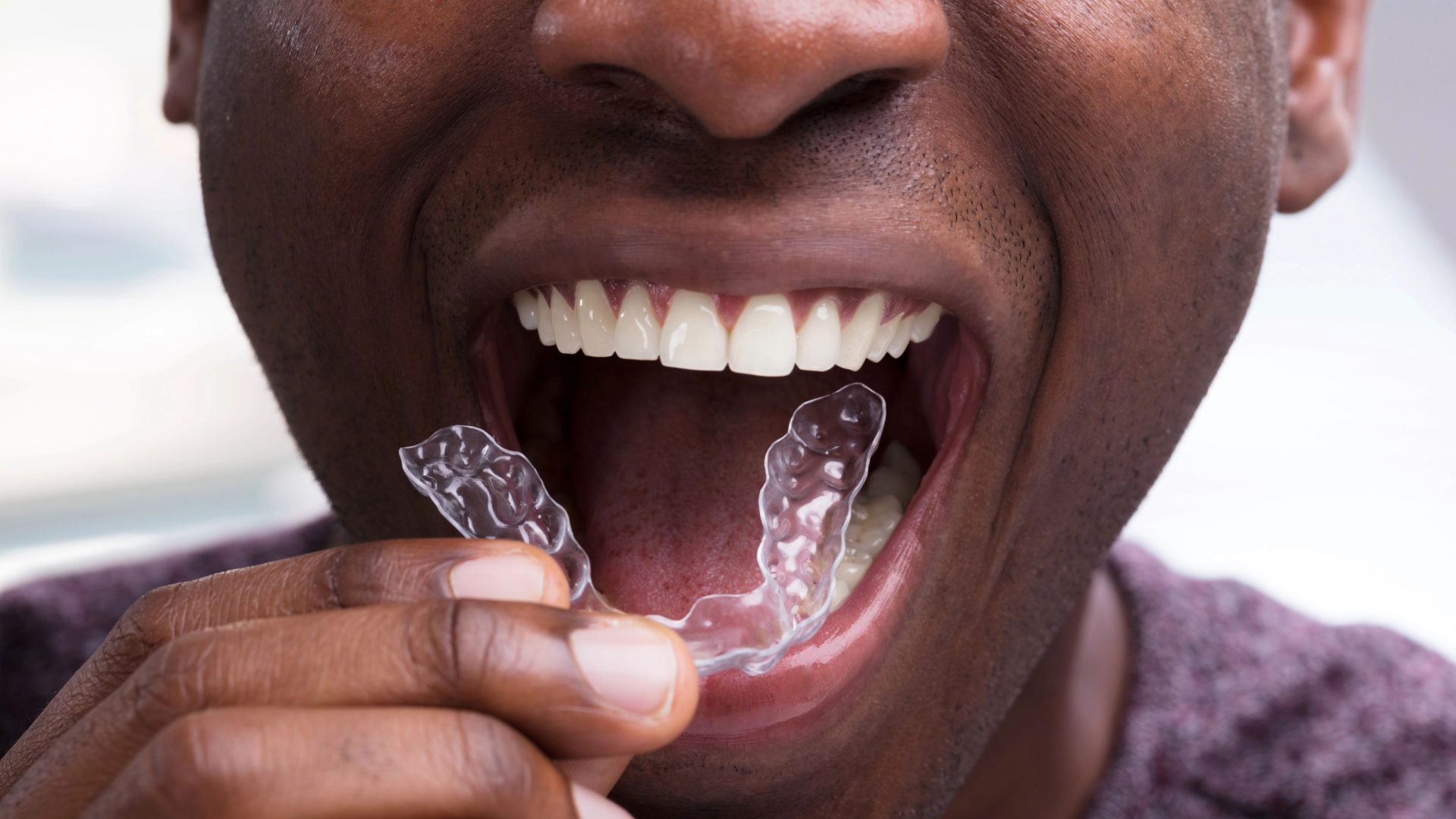 Dental Implant