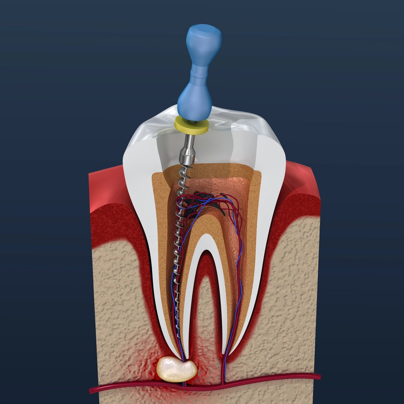 Dental Implant