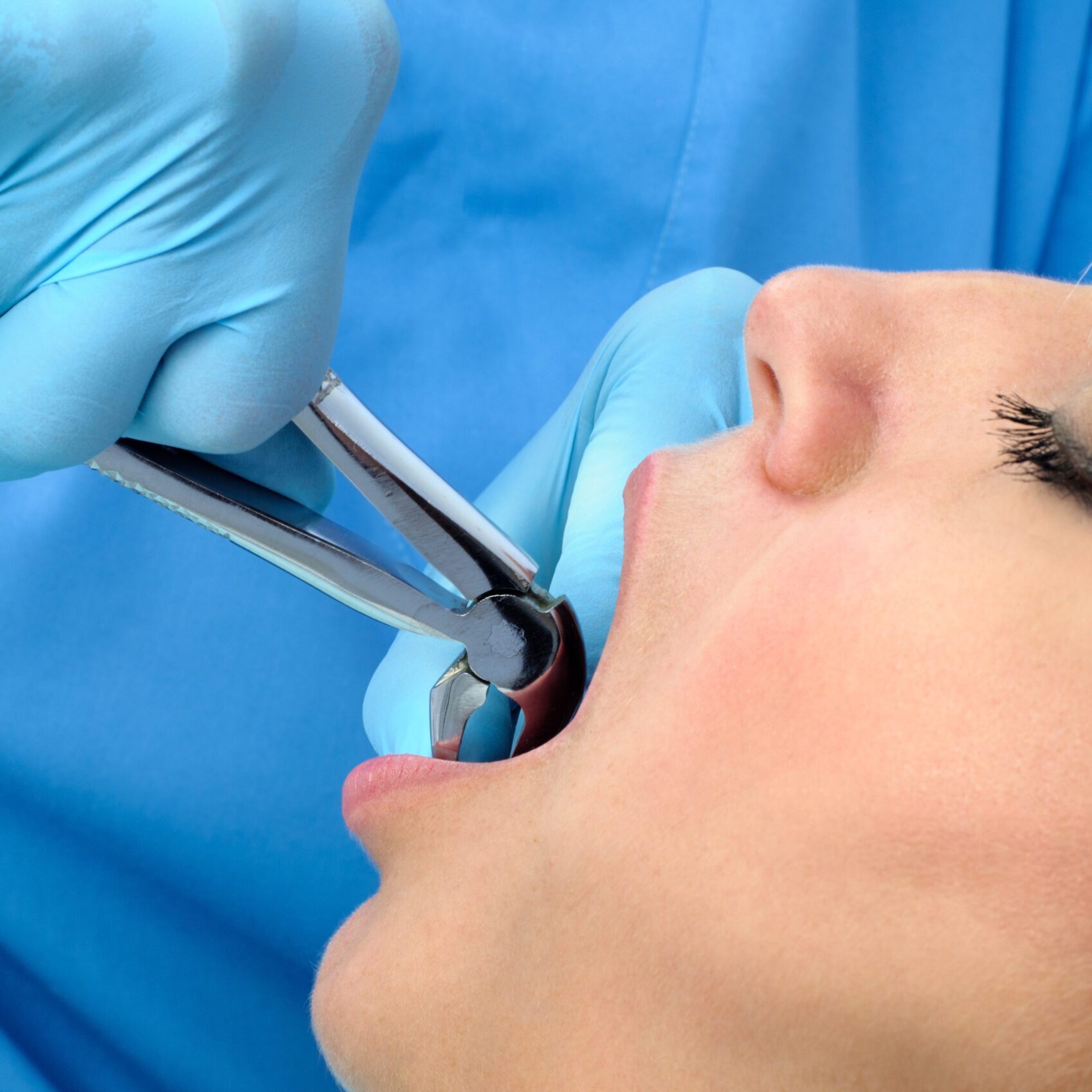Dental Implant